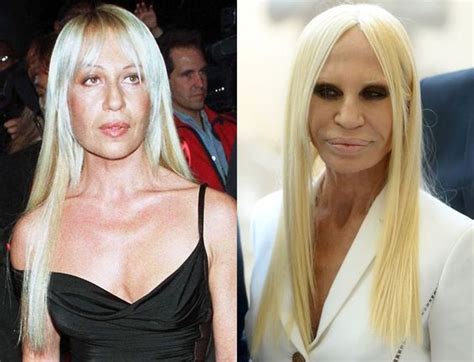 plastische chirurgie versace|donatella Versace cosmetics.